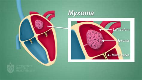 myxoma|myxoma meaning.